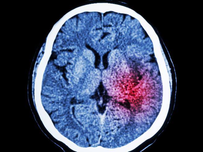 Quelle est l&rsquo;hémorragie cérébrale qui a affecté van der Sar