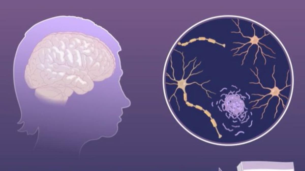 La maladie d'Alzheimer, les changements silencieux dans le cerveau qui ...