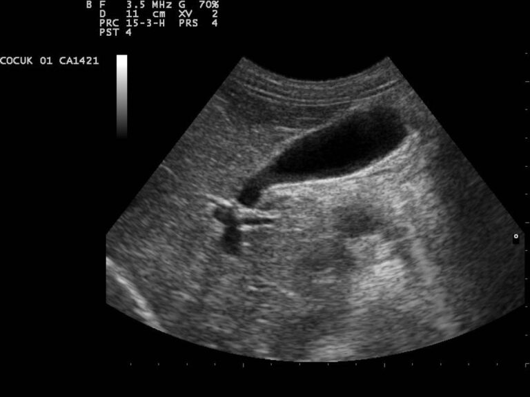 Prévention, symptômes, traitements : ce qu'il faut savoir sur le cancer de la vésicule biliaire. Alarme chez les moins de 50 ans