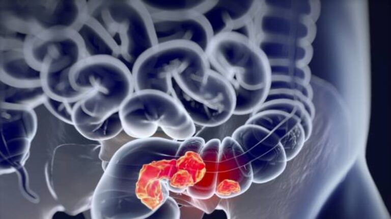 Cancer du côlon droit métastatique: un nouveau médicament parvient à ralentir la croissance de la maladie et à prolonger la survie