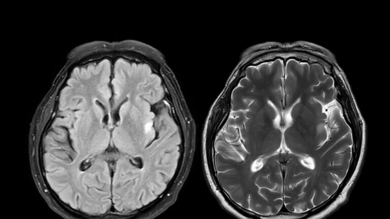 Alzheimer, le régime méditerranéen peut « compenser » le risque génétique de tomber malade