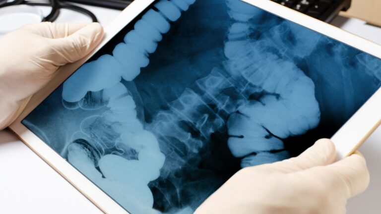 Cancers colorectaux métastatiques : campagne de sensibilisation aux tests moléculaires pour de meilleurs traitements