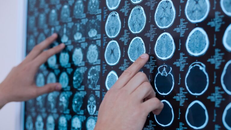 Autisme et Alzheimer : il existe un lien biologique (qui pourrait changer la façon dont on les traite)