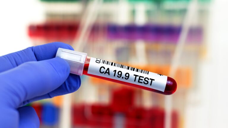 Cancer du pancréas, deux nouveaux marqueurs utiles au diagnostic précoce identifiés dans le sang