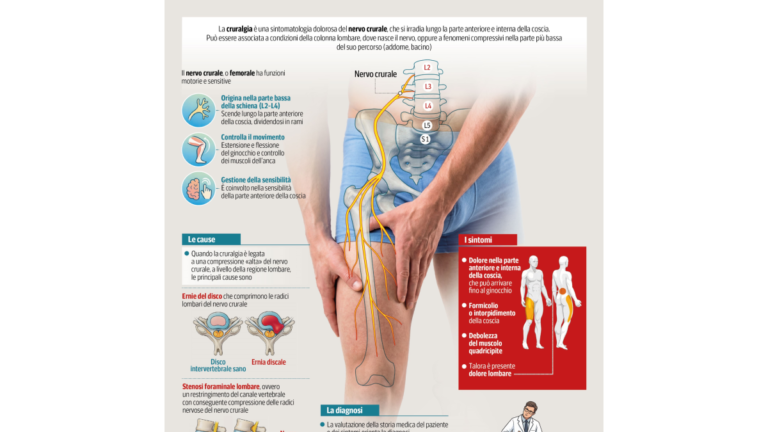 Cruralgie | Corriere.it