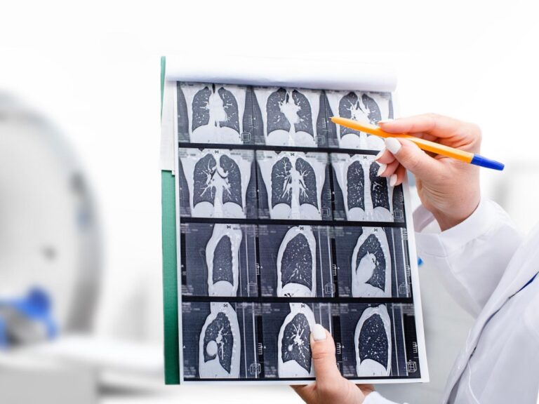 Cancer du poumon, nouveau traitement disponible en Italie pour les patients à un stade avancé et porteurs d&rsquo;une mutation Egfr