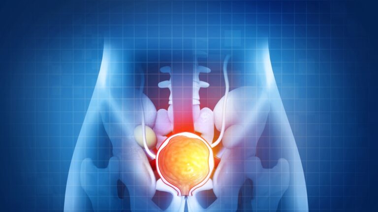 Cancer agressif de la prostate, un nouveau médicament ajouté au traitement standard améliore les chances de guérison