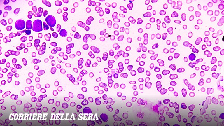 Leucémie : pourquoi les cellules tumorales échappent à la transplantation. À l’horizon, de nouvelles stratégies thérapeutiques