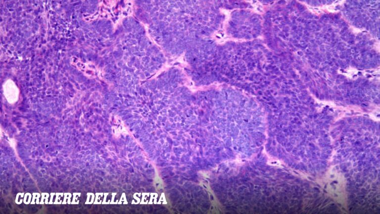 Qu&rsquo;est-ce que le carcinome basocellulaire ou basaliome diagnostiqué par le rappeur Salmo