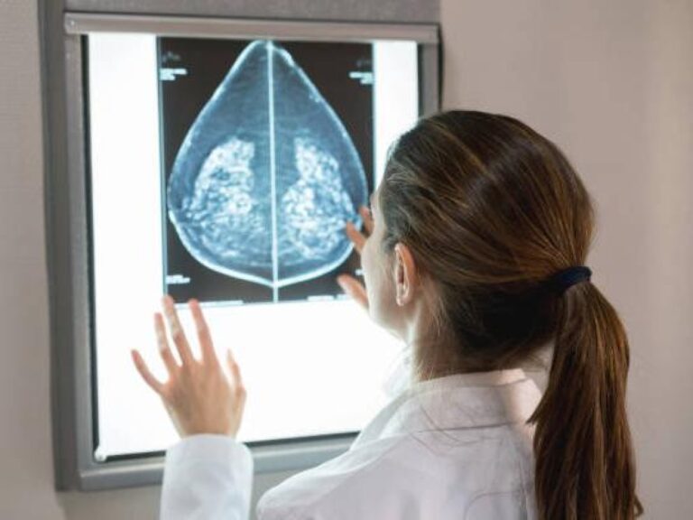 Cancer du sein triple négatif : une double « attaque » pour cibler les cellules tumorales