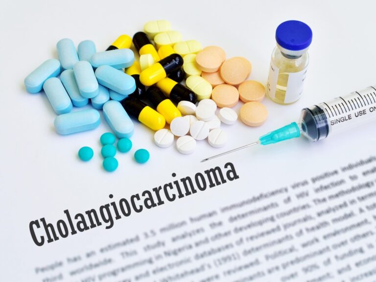 Qu&rsquo;est-ce que le cholangiocarcinome, une tumeur hépatique « difficile » (à découvrir et à traiter) qui donne peu de symptômes et se développe rapidement